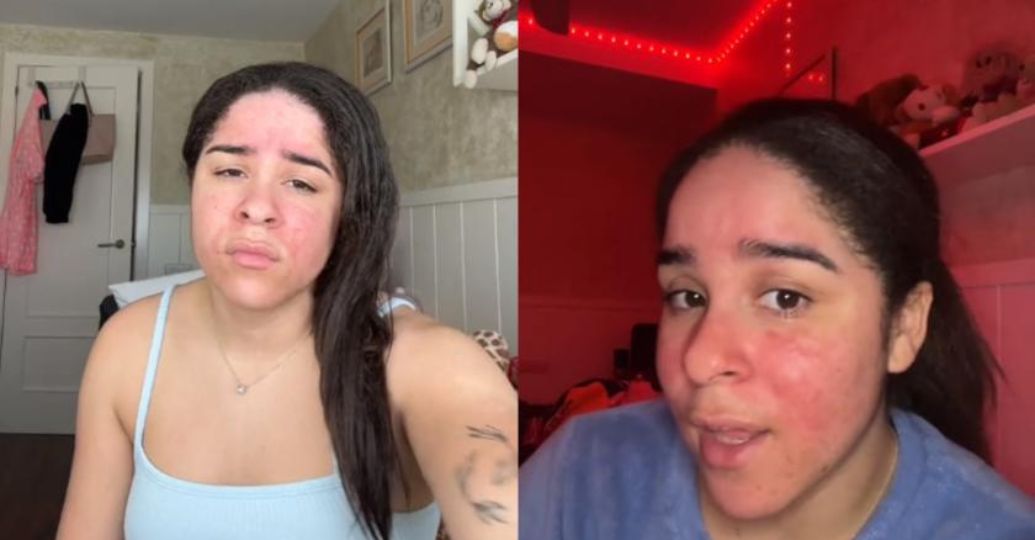 Joven española es alérgica al agua: su propio sudor y lágrimas la irritan