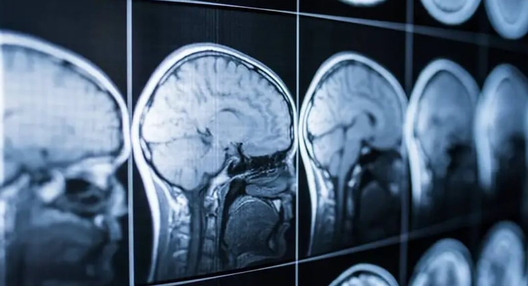 Científicos en China lograron revivir el tejido cerebral de un humano que llevaba congelado 18 meses