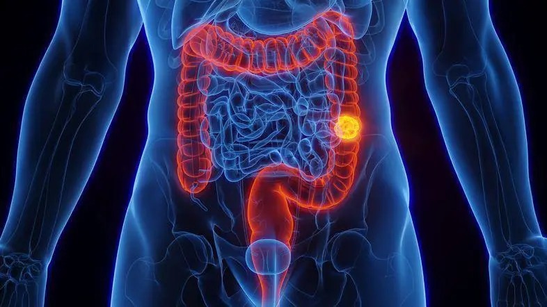 Cáncer colorrectal: le contamos las claves para un diagnóstico temprano. Preste mucha atención