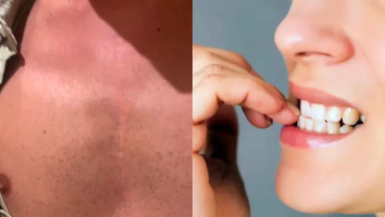 ¿Se come las uñas? ¡Atento! Joven fue sometido a cirugía de corazón abierto por esa práctica