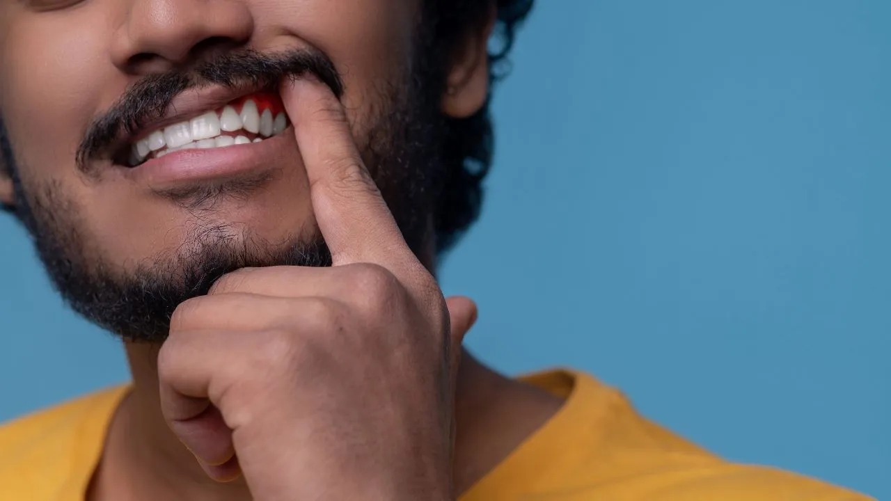 Sangrado de encías: ¿qué hacer si esto le sucede? Aquí le contamos lo que necesita saber
