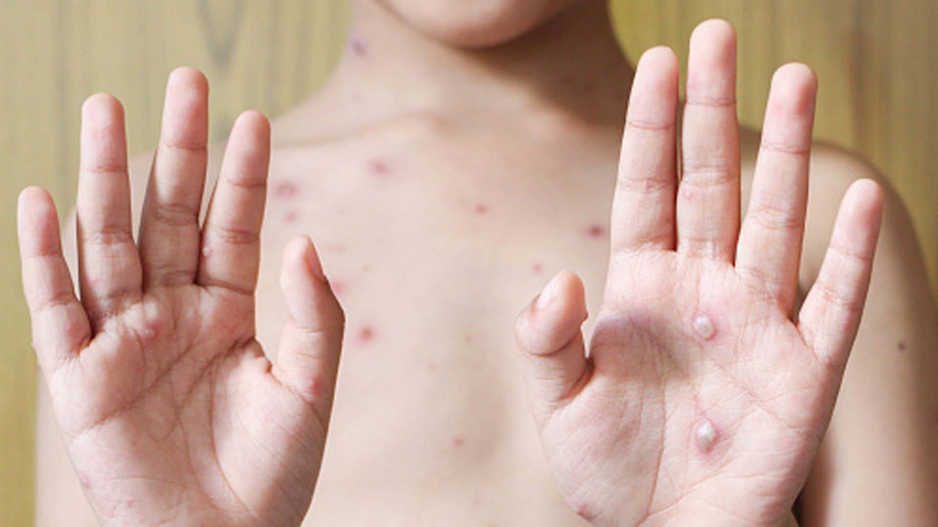 ¡Pilas! Estos son los síntomas de la viruela del mono: OMS ya emitió una alerta sanitaria mundial