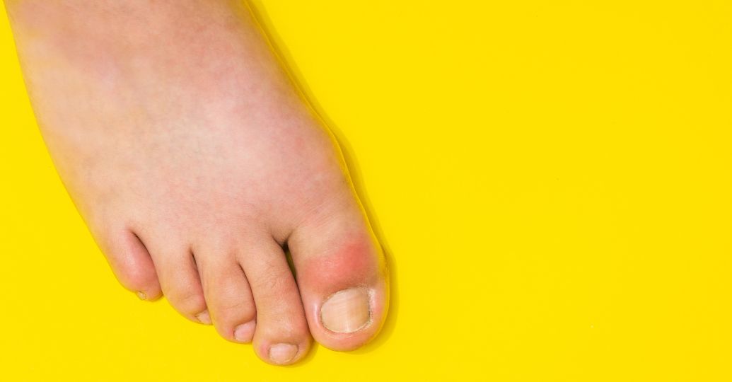 Esta sería la principal causa de la gota: no es el estilo de vida