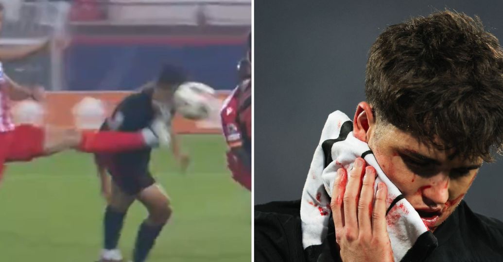 Al jugador del Barcelona Paul Cubarsí le cogieron nueve puntos en el rostro tras fuerte golpe: así quedó