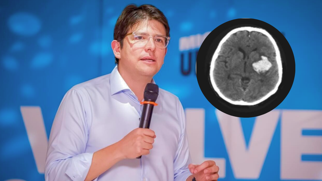 ¿Qué es el 'sangrado intracraneal agudo'? La razón de la operación de emergencia a Miguel Uribe