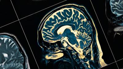 ¿Por qué da la demencia?