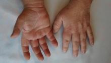 Acromegalia: así puede reconocer esta enfermedad que genera cambios en las extremidades y el rostro