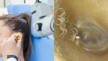 Doctor descubrió que una araña vivía en el oído de una mujer